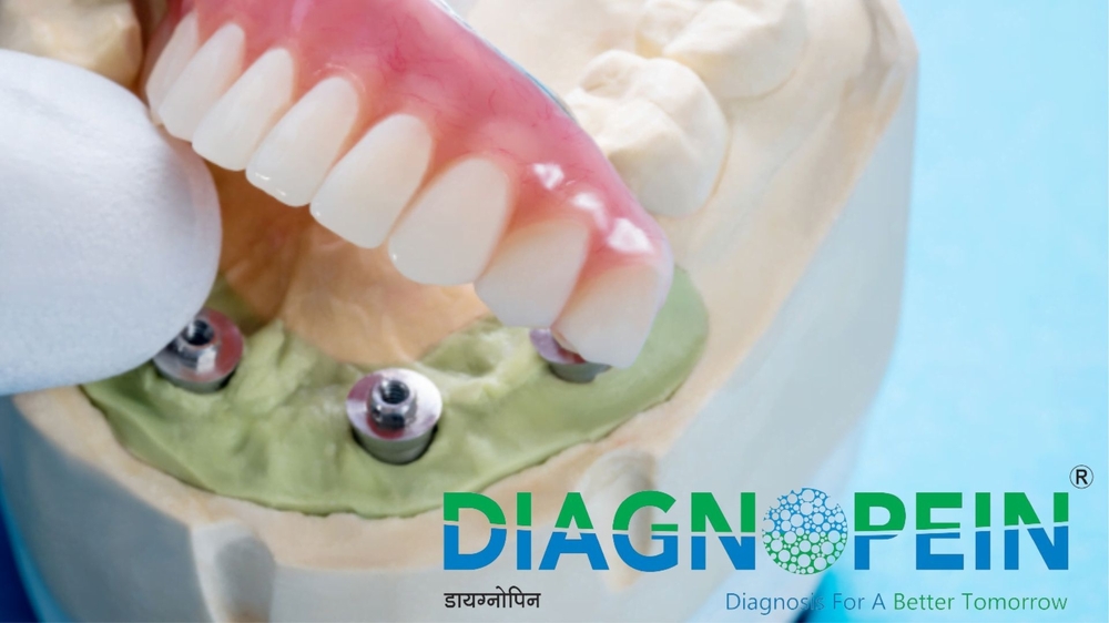 Full Mouth Dental Implant Diagnopein.jpg